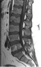   -What type of imaging is displayed in this image? A)  T1 MRI B)  T2 MRI C)  STIR D)  MRI myelography