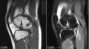   -These are sagittal T1 (left)  and T2 (right)  MRIs of the knee of a gymnast who had a hard landing on extended knees. Based on imaging characteristics, what do the arrows indicate? A)  Fatty tumor B)  Bone marrow edema C)  A fracture line D)  Ossification