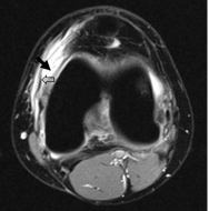   -This is an axial T2 image at the level of the femoral condyles. The open arrow points to the medial patellar retinaculum. What does the solid arrow point to? A)  Edema B)  Fatty tumor C)  Hemorrhage D)  Osteogenic tumor