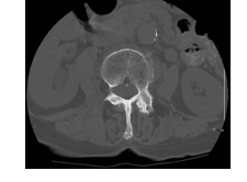   -Refer to the figure. What imaging method is displayed in this axial scan of the lower thoracic spine? A)  CT, soft tissue window B)  CT myelogram C)  CT, bone window D)  3D CT