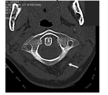   -Refer to the figure. In this image, the arrow points to: A)  Muscle B)  Tendon C)  Entrapped air D)  Intermuscular fat plane