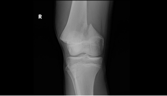 <strong> -Refer to the figure. Radiographic assessment of a fractured bone must include:</strong> A) Two views at right angles to each other B) The routine radiographic exam for the most proximal joint C) An AP view of the contralateral limb to assess normal values D) The routine radiographic exam for the most distal joint