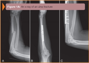<strong> -Refer to the figure. Name the bone and characteristic of the fractures:</strong> A) Midshaft of the ulna, incomplete, displaced B) Midshaft of the radius, incomplete, displaced C) Midshaft of the ulna, complete, displaced D) Midshaft of the radius, complete, displaced