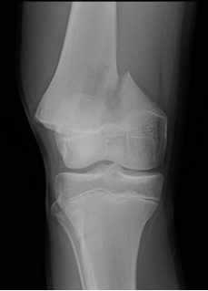 <strong> -Refer to the figure. The _______is fractured in the most common epiphyseal injury pattern, a Salter-Harris ________:</strong> A) femur; type 1 B) femur; type 2 C) tibia; type 1 D) tibia; type 2