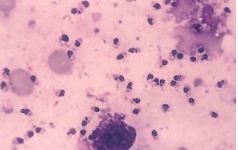 A traveler returning from a trip to the Andes Mountains in Central America noticed the formation of a boil on his lower leg. His physician opened the lesion and sent the purulent material to the lab for analysis. A stained preparation of the submitted material is shown here. Name the parasitic form seen in this view:   A)  Amastigote form B)  Leptomastigote form C)  Promastigote form D)  Trypomastigote form