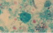Name the parasite shown in the following image:   A)  Dientamoeba fragilis B)  Entamoeba coli C)  Entamoeba hartmanni D)  Iodamoeba bütschlii