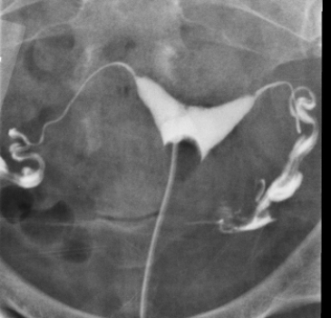   This hysterosalpingogram shows a patient with a: A)  bicornuate uterus that may be related to an increased incidence of spontaneous abortions. B)  severe Müllerian duct anomaly that is incompatible with normal pregnancy and delivery. C)  history of multiple pelvic infections and obstructed fallopian tubes that are preventing successful pregnancy. D)  multiple uterine fibroids that explain the recent onset of pelvic pain.
