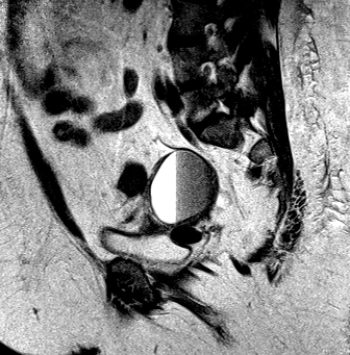   This sagittal MRI shows a patient with: A)  an endometrioma. B)  normal yolk sac. C)  polyhydramnios. D)  uterine tumor.