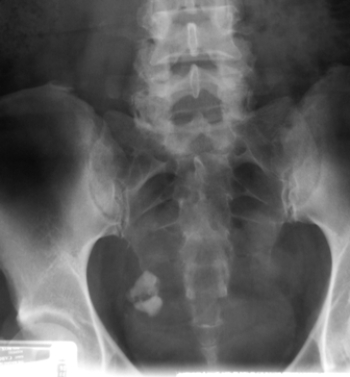   The above radiograph shows that the patient has: A)  an ectopic pregnancy. B)  a pelvic metastatic disease. C)  a phlebolith. D)  an ovarian teratoma.