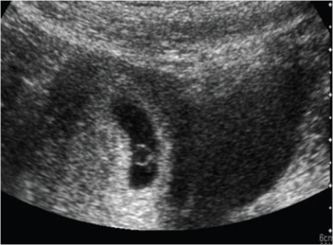   This ultrasound image was done on a woman who is several weeks pregnant and shows: A)  evidence of a blighted ovum. B)  a sign of impending spontaneous abortion. C)  a subchorionic hemorrhage. D)  a normal yolk sac.