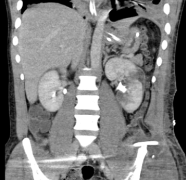 <strong>  This enhanced CT image is consistent with:</strong> A) a history of painless obstructive jaundice. B) a patient with colicky left flank pain suspicious for ureteral calculus. C) a trauma patient with a lacerated kidney. D) an alcoholic with cirrhosis. <div style=padding-top: 35px> 