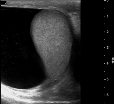 <strong>  This scrotal ultrasound confirms the clinical diagnosis of:</strong> A) varicocele. B) epididymal cyst. C) large hydrocele. D) testicular tumor. <div style=padding-top: 35px> 
