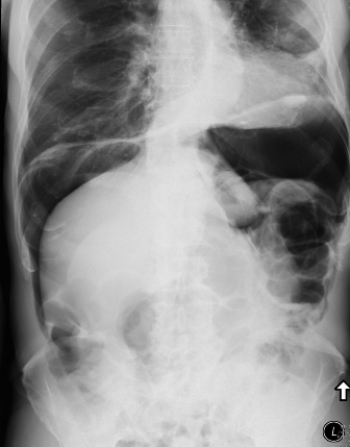   This image shows a patient who: A)  needs a colonoscopy for diagnosis. B)  has a perforated viscus. C)  has a cirrhotic liver. D)  can be treated with IV antibiotics.