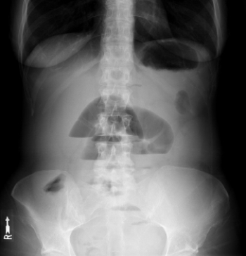   The patient in this image suffers from: A)  a small bowel obstruction. B)  a large bowel obstruction. C)  free intraperitoneal air. D)  appendicitis.