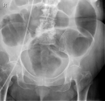   There is an obstruction in this patient's: A)  mid-small bowel. B)  rectum. C)  mid colon. D)  ileocecal valve.