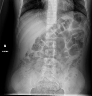  There is a very small but important finding in this patient with acute abdominal pain: What is it? A)  A calcified gallstone B)  Large bowel obstruction C)  Appendicolith D)  Free intraperitoneal air