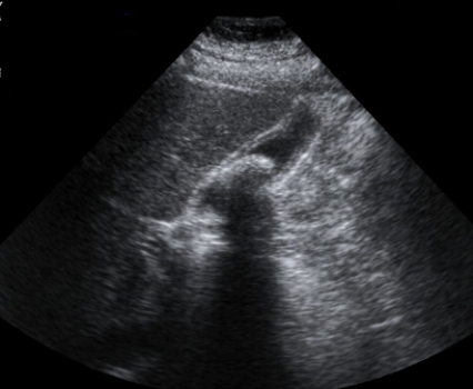   This ultrasound image shows that this patient has: A)  liver cancer. B)  cholelithiasis. C)  liver cyst. D)  blood in Morrison's (hepatorenal)  pouch.