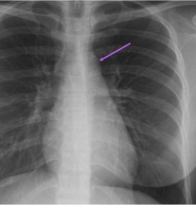   In this AP projection the arrow indicates: A)  a normal arch of aorta. B)  a dilated pulmonary trunk. C)  an enlarged tracheobronchial lymph node. D)  a trachea shifted to left due to mass effect.