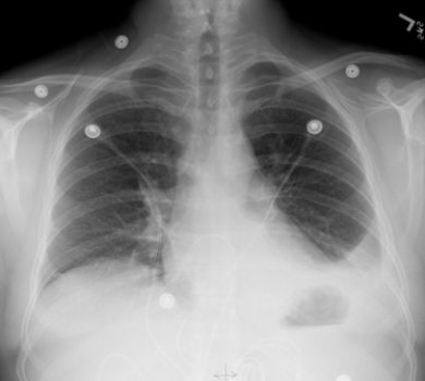   This portable AP chest radiograph shows a patient with: A)  acute pulmonary edema. B)  left lower lobe pneumonia without pleural effusion. C)  a left pleural effusion. D)  bronchogenic carcinoma in the lingula of the left upper lobe.