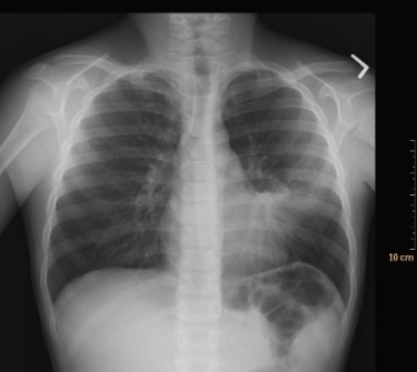  What condition does the image depict? A)  Pneumothorax B)  Pleural effusion C)  Bacterial pneumonia D)  Congestive heart failure