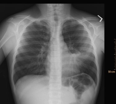   This image includes a classic radiographic finding. What is the name of this radiologic sign, and what is the most likely disease? A)  Reticulonodular pattern; interstitial lung disease B)  Silhouette sign; pneumonia C)  Cephalization of the pulmonary vascular pattern; congestive heart failure D)  Silhouette sign; metastatic malignancy