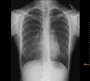   This frontal radiograph suggests an increase in lung density associated with an apparent silhouette sign along the right border of the heart. However, after a lateral view was also examined, the radiologist concluded that the patient's lungs were normal. Why? A)  The radiograph is an AP rather than the normal PA view. B)  The patient has fibrous granulomas. C)  The patient has pectus excavatum. D)  The patient is recovering from heart bypass surgery.
