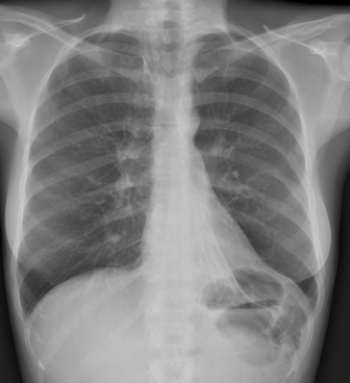  Based on the image, what does this patient likely have? A)  Left lower lung atelectasis B)  Perforated left hemidiaphragm C)  Left pleural effusion D)  Paraspinal mass