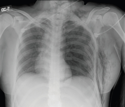   This patient is suffering from which symptoms? A)  Fever and cough B)  Trauma and limited air exchange on the left C)  Abdominal pain; preoperative radiograph D)  Known metastatic diseases and mediastinal adenopathy