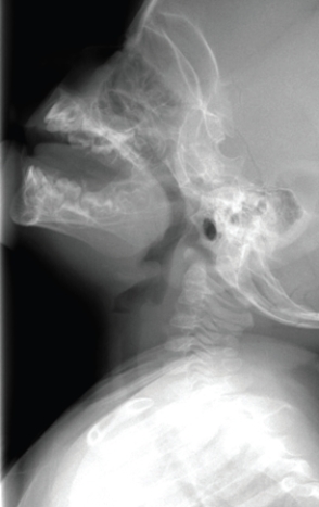   This image shows a child with: A)  allergies and enlarged adenoids causing snoring. B)  an (potentially fatal)  acute epiglottitis. C)  failure to thrive and chronic dysphagia. D)  a viral illness that will respond readily to conservative treatment.
