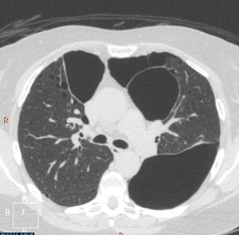   The axial CT shown depicts that this patient has which disease? A)  Emphysema B)  Interstitial lung disease C)  Nodular lung disease D)  Pneumothorax