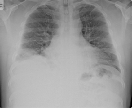  Based on the image, what treatment will the patient likely receive? A)  Chemotherapy B)  Cardiac transplant C)  Surgery D)  Antibiotics