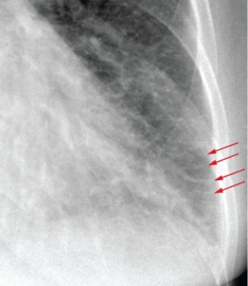   The red arrows in this image highlight a finding that is associated with: A)  congestive heart failure. B)  pneumonia. C)  silicosis. D)  emphysema.