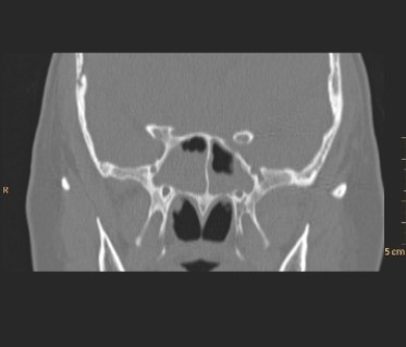   This coronal image from paranasal sinus CT depicts a patient with: A)  mucoperiosteal thickening and fluid in the sphenoid sinus. B)  invasive squamous cell carcinoma of the maxillary sinus. C)  temporalis muscle calcification indicating the presence of temporal arteritis. D)  an incidental pituitary macroadenoma.