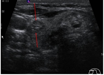   This image is a transverse ultrasound scan of a thyroid gland. The structure indicated by the red arrows is: A)  the trachea. B)  a thyroid nodule. C)  the common carotid artery. D)  a parathyroid gland.
