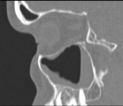   Based on this sagittal CT, you can conclude that the patient: A)  was upright when the CT was done and has circumferential mucoperiosteal thickening of the maxillary sinus. B)  was supine when the CT was done and the patient has fluid in the dependent portion of the maxillary sinus. C)  has had a blowout fracture of the orbit. D)  has a maxillary sinus tumor.