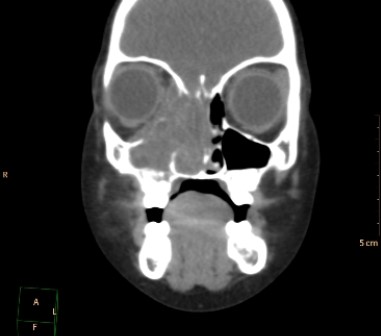   This CT scan depicts a patient with: A)  right maxillary and right-sided ethmoid sinusitis. B)  acute right orbital blow-out fracture with hematoma in the right orbit. C)  right-sided invasive sino-nasal tumor that involves the orbit. D)  commonly seen asymmetry in the development of the paranasal sinuses.