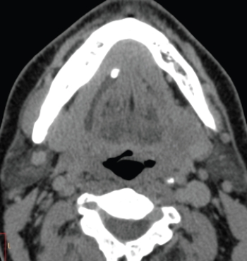   Based on this axial CT, this patient would likely: A)  have pain when eating. B)  need immediate surgery because of epiglottitis. C)  have had a stroke because of an occluded vertebral artery. D)  have dental pain because of an abscessed incisor.