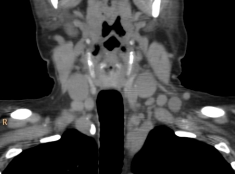   This coronal CT shows: A)  a patient with severe dyspnea. B)  a patient with lymphoma. C)  a patient with chronic dysphagia. D)  a patient with cervical pain.