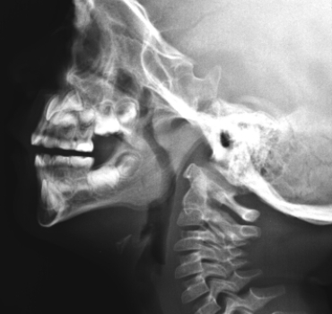  This image shows a pediatric patient that has: A)  a maxillary sinus abscess. B)  enlarged adenoids. C)  epiglottitis. D)  periodontal abscess.