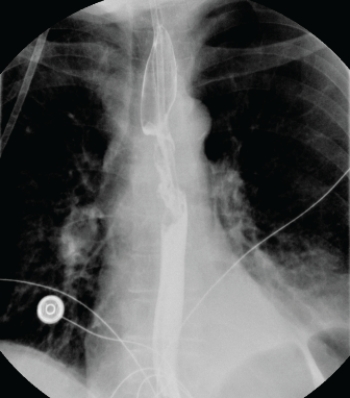   The esophagram shows a patient with: A)  progressive dysphagia caused by esophageal cancer. B)  regurgitation of undigested food from a Zenker's diverticulum. C)  tracheobronchial fistula. D)  hiatal hernia and GERD.