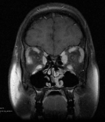   This contrast-enhanced coronal MRI of the orbits shows a finding related to one of the extraocular muscles associated with: A)  trauma. B)  acute onset of blindness. C)  Graves' disease. D)  strabismus.