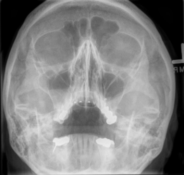   Based on this image, this patient is being followed for which of the following? A)  Response to radiation therapy for a paranasal sinus tumor B)  Response to medical treatment for acute sinusitis C)  Reaction to the inhalation of noxious fumes D)  Post-surgical complications after sinus surgery