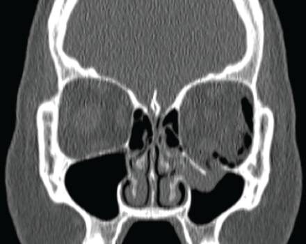   This coronal CT depicts a patient who: A)  caught a softball with her left eye. B)  has a left nasal tumor. C)  has seasonal sinus allergies. D)  has exophthalmos.