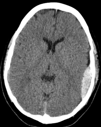   This image reveals the presence of: A)  an epidural hematoma. B)  a subdural hematoma. C)  an acute ischemic stroke. D)  subarachnoid hemorrhage.