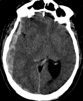   The patient in this image has which of these conditions? A)  An epidural hematoma B)  A subdural hematoma C)  An acute ischemic stroke D)  A subarachnoid hemorrhage