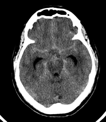   The pathology shown in the image above is associated with: A)  chronic headache. B)  acute onset of aphasia. C)  chronic left-sided weakness. D)  acute onset of what was likely reported as the  worst headache of my life. 