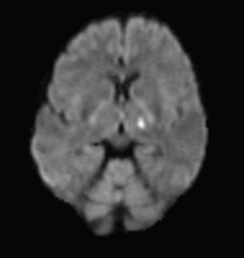   The very bright intensity in the above DWI indicates that this patient: A)  has metastatic disease. B)  had an acute ischemic stroke. C)  has an AVM. D)  has MS.