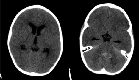  The axial CT images shown are two different slices from one study on a pediatric patient. Your likely diagnosis is: A)  hemorrhagic stroke. B)  obstructive hydrocephalus. C)  subarachnoid hemorrhage. D)  uncal herniation.
