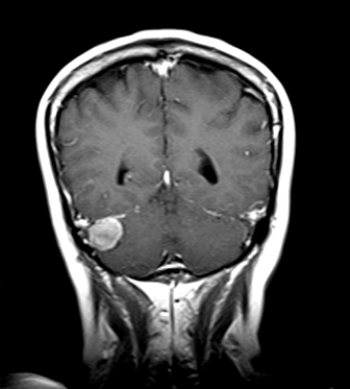   The patient in this image has: A)  a meningioma. B)  hydrocephalus. C)  a cephalhematoma. D)  uncal herniation.