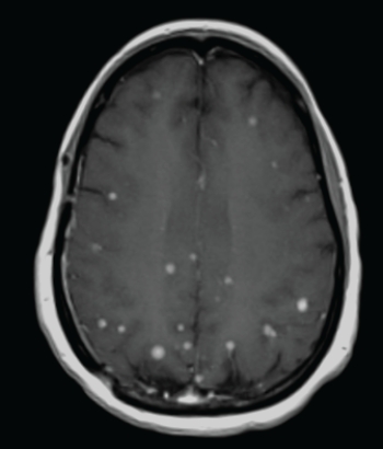   The above axial contrast-enhanced MRI is consistent with: A)  dementia. B)  metastatic breast cancer. C)  Kuru. D)  TIAs.